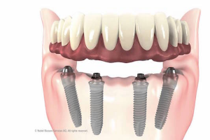 3) Implant Supported Dentures in akshaynagar