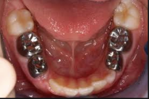teeth Fillings in Bangalore