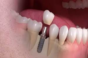 1) Single Tooth Implants in akshaynagar