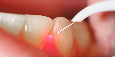 Laser Gum Treatment full mouth in akshaynagar, bangalore