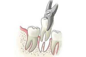 tooth Extraction in bangalore