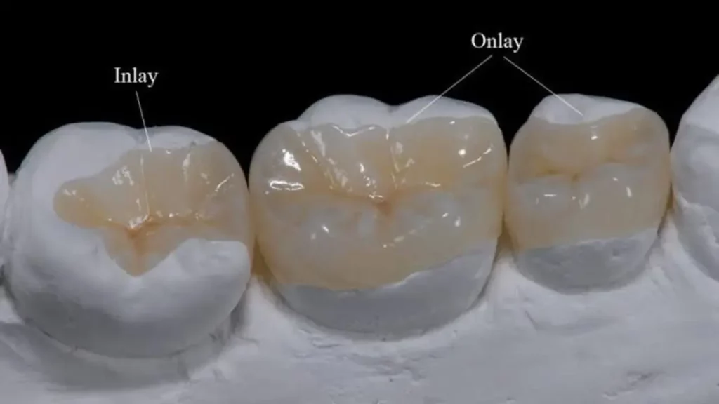 teeth inlay and onlay treatment in akshaynagar, bangalore